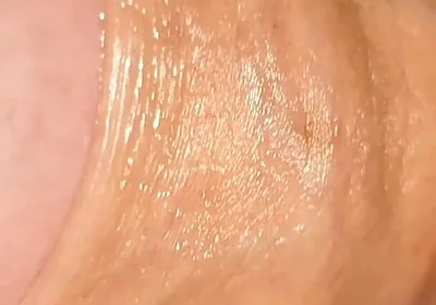 Difficult Fluid Control Due to Straight Phimosis.