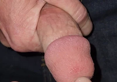 Gaping Urethra - Marker and Pinky Insertion