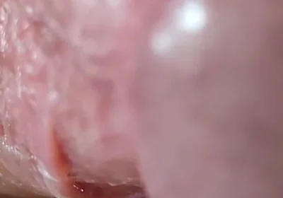 Opening the Scar of the Rough Frenulum!